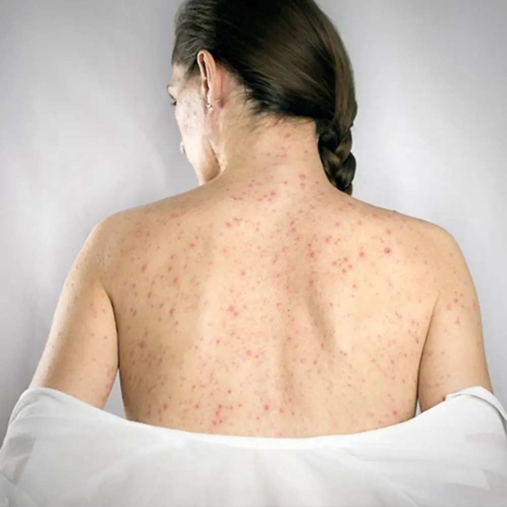 Espalda de una mujer con sintomas de sifilis